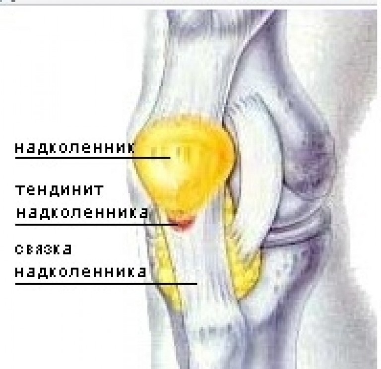 Боль коленной связки. Повреждение сухожилия надколенника. Тендинит надколенника симптомы. Тендиноз сухожилия надколенника. Колено прыгуна тендинит надколенника.