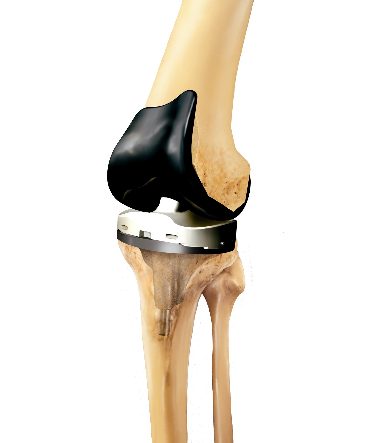 Эндопротезирование коленного сустава клиника. Эндопротезирование коленного сустава. Smith nephew эндопротез коленного сустава. Протез коленный Зиммер. Эндопротез коленного сустава Maxx Orthopedics.