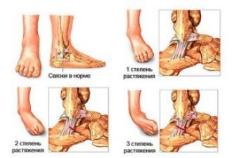 Is plaster cast for sprains Symptoms of an ankle sprain